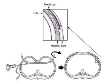 Nuss Procedure for Pectus Excavatum Technique: Minimally Invasive Repair of Pectus Excavatum ...