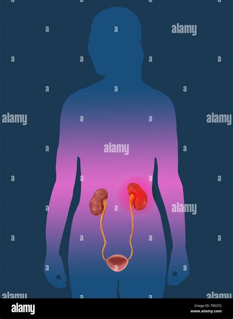 Kidney condition hi-res stock photography and images - Alamy