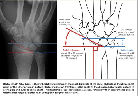 Buckle (Greenstick) Fracture of the Distal Radius - Sports Medicine Review