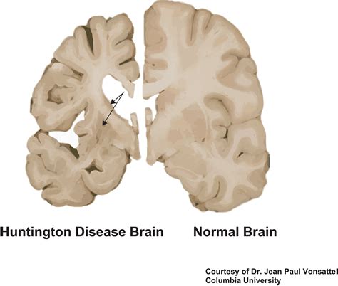 Huntington's Disease Brain - Explanation Of Huntingtons Disease ...