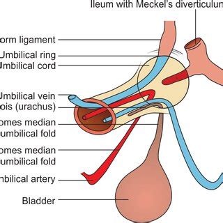 3: Abnormalities of Omphalomesenteric duct | Download Scientific Diagram