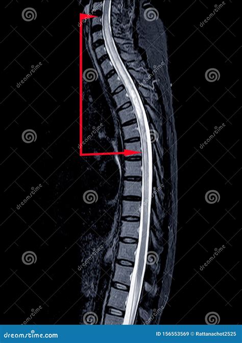 Transverse Myelitis Mri - The Radiology Assistant Myelopathy - Magnetic resonance imaging (mri ...