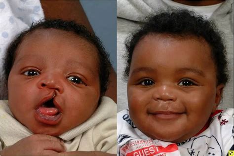 Cleft Palate and Cleft Lip – Causes, Symptoms and Treatment | Healthtian