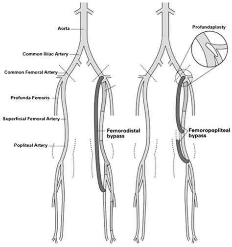 Femoral Popliteal Bypass Surgery Best Medical Care Se - vrogue.co