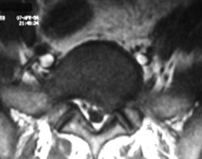 Lumbar Spine Mri Bulging Disc