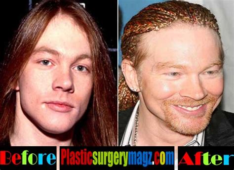 Axl Rose Plastic Surgery Before and After Photos | Plastic Surgery Magazine