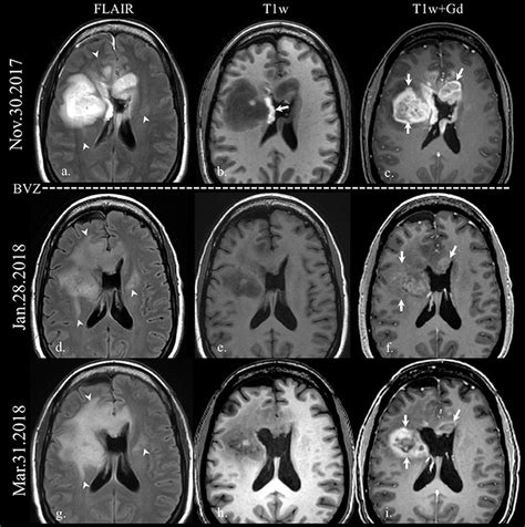 Frontal Lobe Brain Tumor Mri