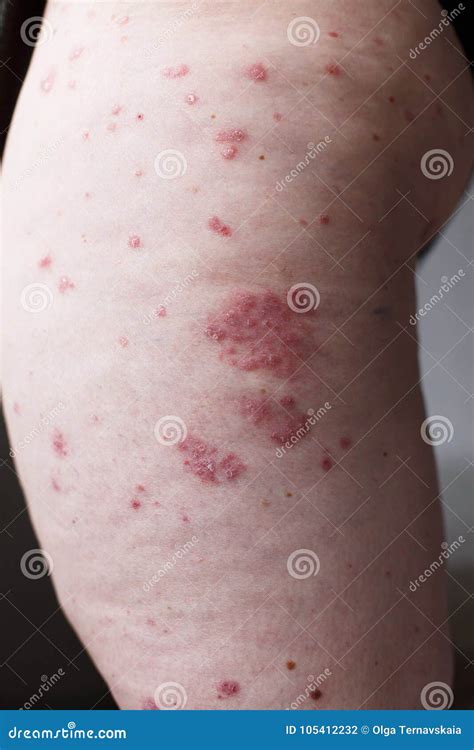 Allergic Rash Dermatitis Eczema Skin on Leg of Patient. Psoriasis and ...