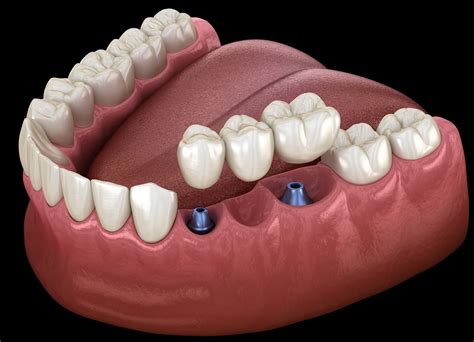 How Bridges and Dentures Perform with Dental Implants | Santa Rosa, CA