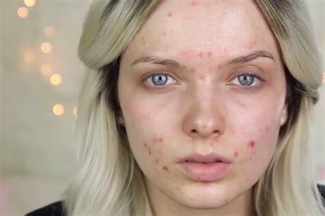 Women are posting makeup-free selfies to spread acne positivity | The ...