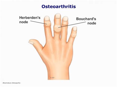 Osteoarthritis of the Fingers HANP03 - Bloomsbury Health Centre