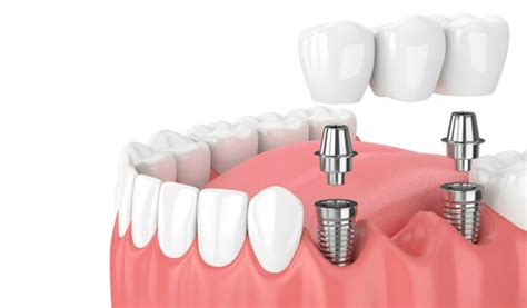 ¿Qué es la implantología dental? - Morales Cervera