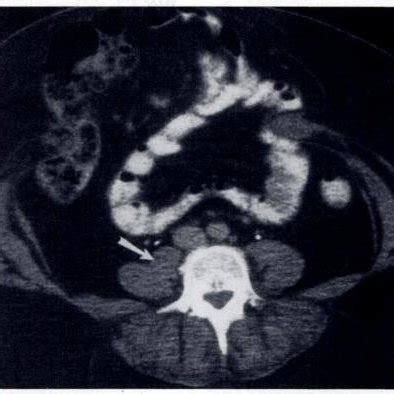 (a) CT scan demonstrates a soft-tissue attenuation nodule, medial to... | Download Scientific ...