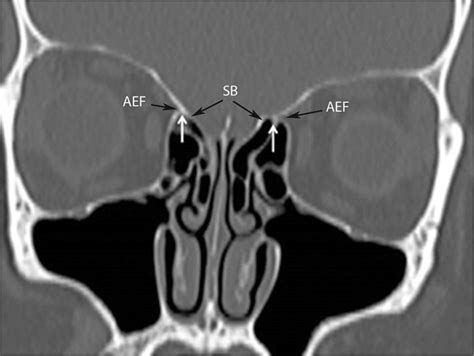 Coronal CT PNS appearance when anterior ethmoidal artery (white arrows)... | Download Scientific ...