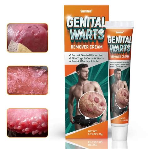 Genital Warts Remover Cream | Ginax Store