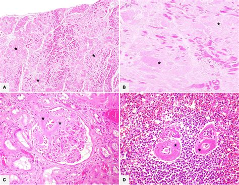 Frontiers | Amyloidosis: What does pathology offer? The evolving field of tissue biopsy