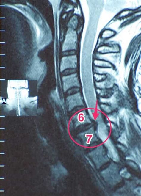 MRI Herniated Disc In Neck