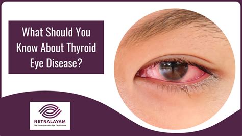 What Should You Know About Thyroid Eye Disease?