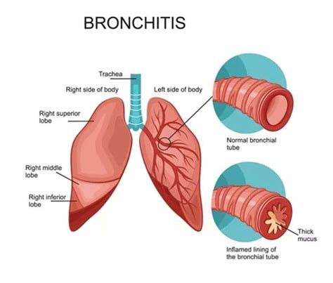 Herbal Remedy for Allergic Bronchitis - AskMeBlogger