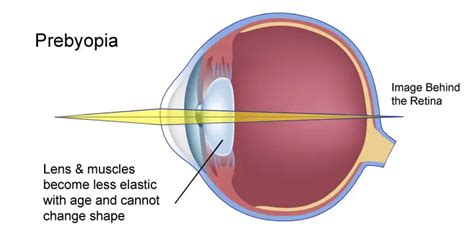 Hyperopia - Symptoms, Causes and Treatment | FYEyes