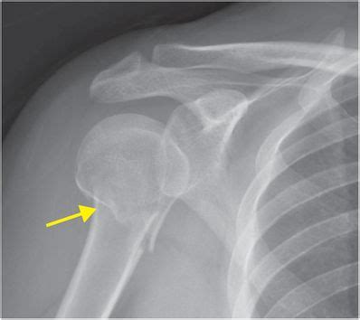 Proximal Humerus Fracture X Ray