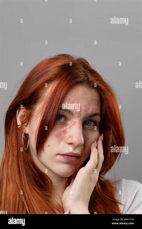 Young woman with acute skin rash on her face. Dermatological problems due to allergy ...