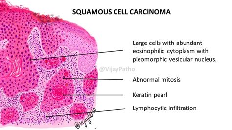 Pathology of SQUAMOUS CELL CARCINOMA - Pathology Made Simple