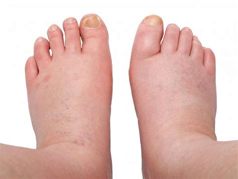 What is Peripheral Edema? (with pictures)