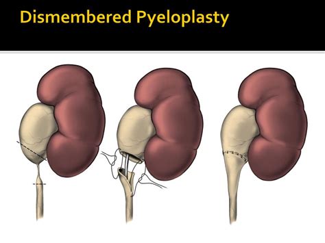 Dismembered Pyeloplasty - Dr. José Alexandre Pedrosa