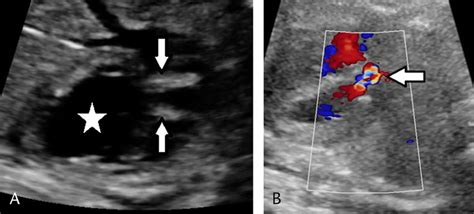 left ventricular outflow tract obstruction. A, Ultrasound image in LVOT... | Download Scientific ...