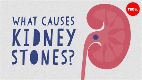 What causes kidney stones? | Health Blog - Read Health Advice on vitaminsicilik