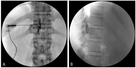 Steroid Injections Nerve Block - Nerve Blocks for Pain Relief: Types, Side Effects, and Uses ...