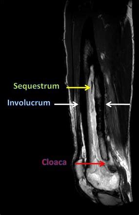 Bony sequestrum | Radiology Reference Article | Radiopaedia.org