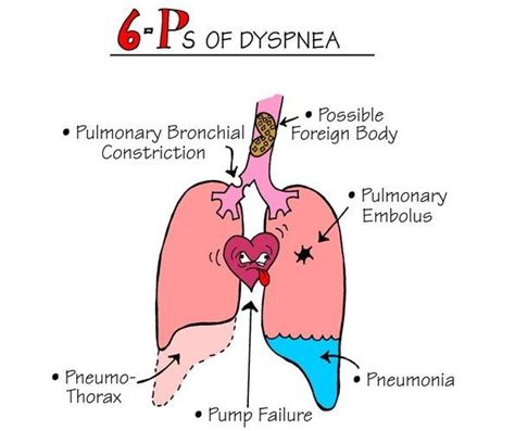 What is Dyspnea : Definition, Symptoms, Causes & Treatment