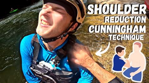 On River Dislocated Shoulder Reduction "Cunningham Technique" - YouTube