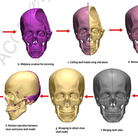 (PDF) Structural and mechanical characterization of custom design cranial implant created using ...