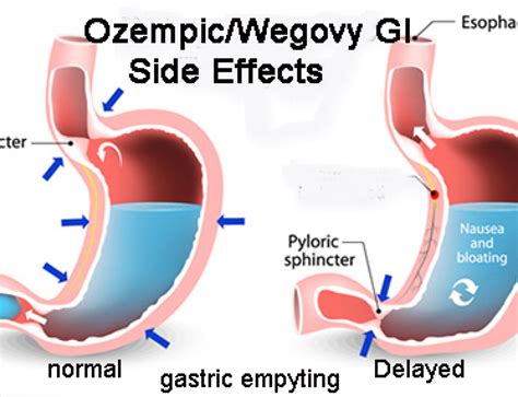 Weight Loss Plateaus on Semaglutides: Mounjaro, Ozempic & Wegovy - Dr ...