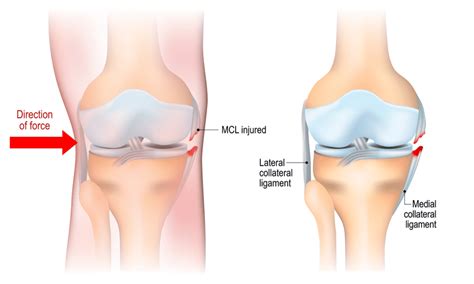 MCL Tears: Elite Sports Medicine + Orthopedics: Orthopedics