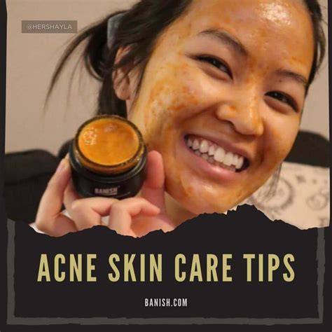 17 Acne Skin Care Tips That Actually Work