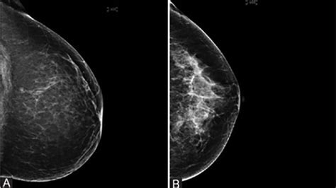 Scattered fibroglandular breast tissue