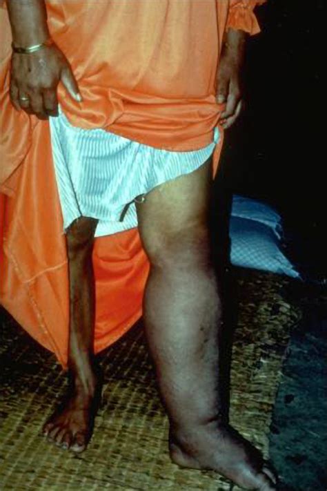 File:Elephantiasis.png - Wikipedia