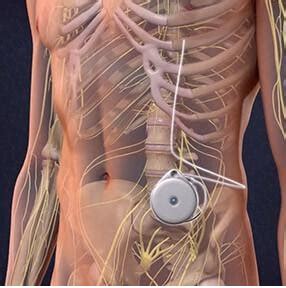 Understanding the Intrathecal Spinal Pump Implant