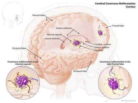 Pin on Ben's cavernous malformation