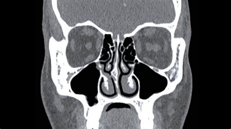 How to read a CT PNS | All points Explained in detail - YouTube