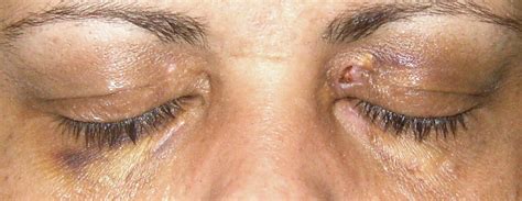 xanthelasma removal surgery