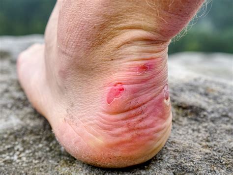 Diabetic Blisters | Care and Treatment | Podiatrist Near Corona