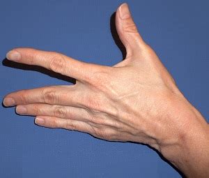 Exercise for a Painful Thumb CMC Joint?