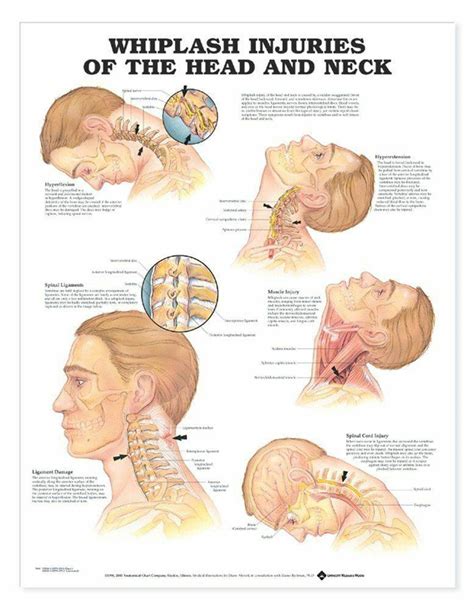 Whiplash Stretches | tunersread.com