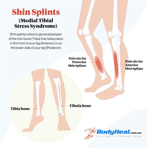 Shin Splints Medial Tibial Stress Syndrome