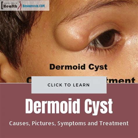 Dermoid Cyst: Causes, Pictures, Symptoms And Treatment